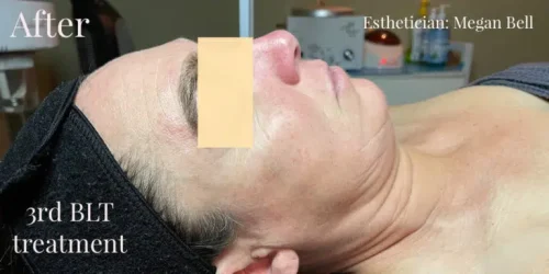 15533-BLT-Facial-a1-768x384.jpg