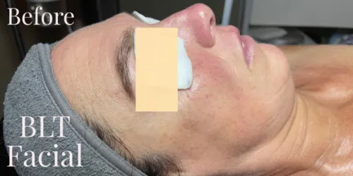15533-BLT-Facial-b1-768x384.jpg