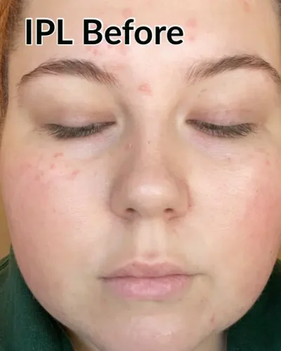 15533-filler-ipl-c3-b1.jpg